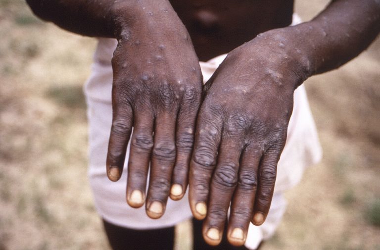 Explainer Monkeypox: मंकीपॉक्स का संक्रमण बढ़ा रहा है चिंता, जानिए कैसे भारत में फैल रही है यह बीमारी