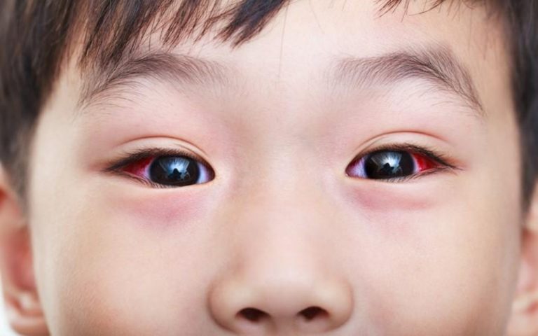 तेजी से फैल रहा Conjunctivitis , बच्चों को कैसे रखें सुरक्षित, जानें यहां