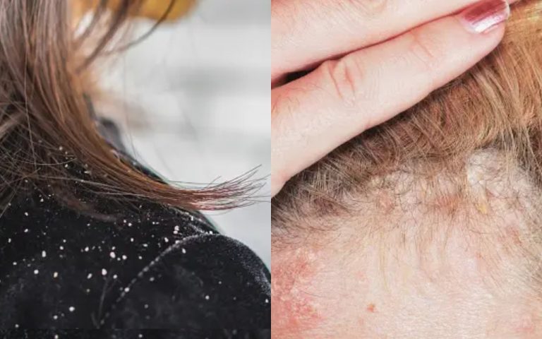 कैसे समझे डैंड्रफ है या स्कैल्प सोरायसिस ? जानिए दोनों का अंतर