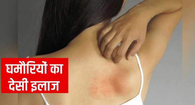 Heat Rash Prickly Heat Home Remedies: गर्मियों में घमौरियों से हैं परेशान, तो ये हर्बल ऑयल दिलायेंगे राहत