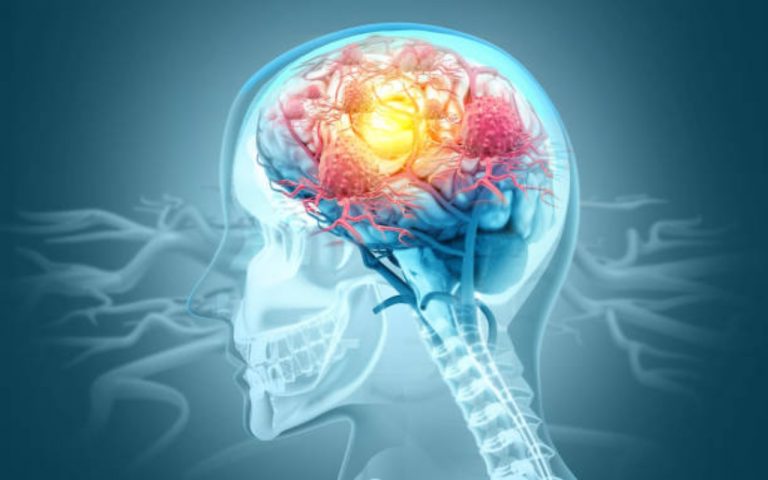 Research Alzheimer’s Treatment :  स्टेम सेल उपचार ने अल्जाइमर के लक्षणों को घटाने की जगाई उम्मीद