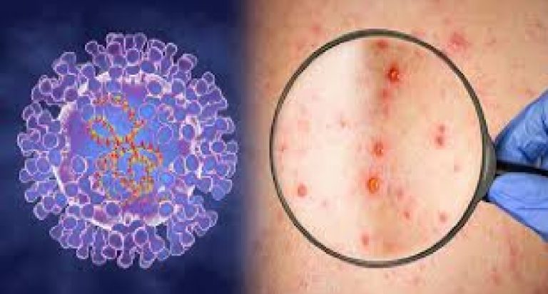 Monkeypox: क्या है मंकीपॉक्स ? इस बीमारी के बारे में जान लें ये 10 जरूरी फैक्ट्स