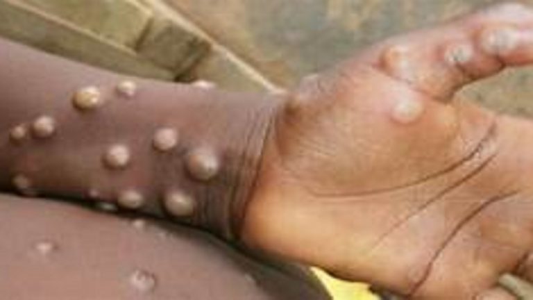 MonkeyPox Bihar: मंकी पॉक्‍स को लेकर स्वास्थ्य विभाग ने जारी की गाइडलाइन, जानें क्या है बचने के उपाय