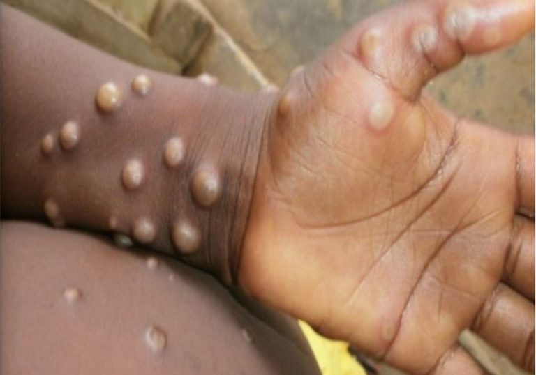Mpox Case: दुनिया में पैर पसार रही नई महामारी, स्वीडन और पाकिस्तान में दर्ज किए गए मामले