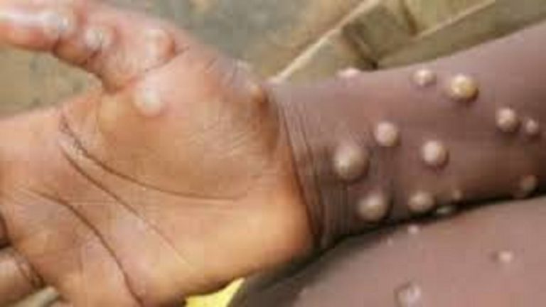 Monkeypox Virus: यूरोप में रेव पार्टी के कारण फैला मंकीपॉक्स! जानें WHO ने क्या कहा
