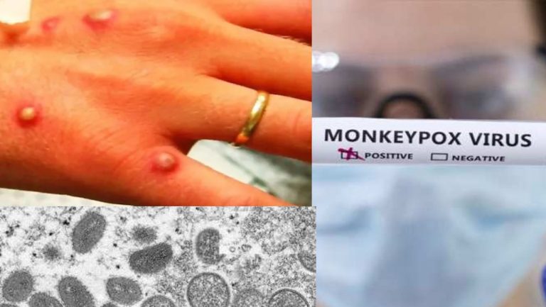 Monkeypox: WHO ने मंकीपॉक्स को लेकर जारी की एडवाइजरी, भारत में अब तक 4 मरीज मिले