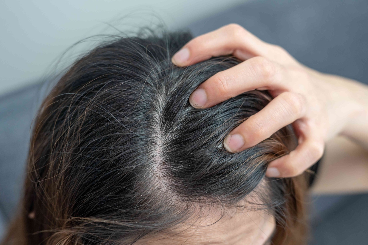 Itchy Scalp Problem