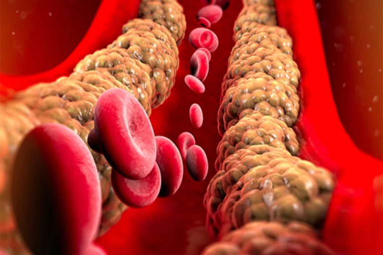 High Cholesterol Symptoms : क्या होते हैं शरीर में कोलेस्ट्रॉल बढ़ने के लक्षण? जानिए