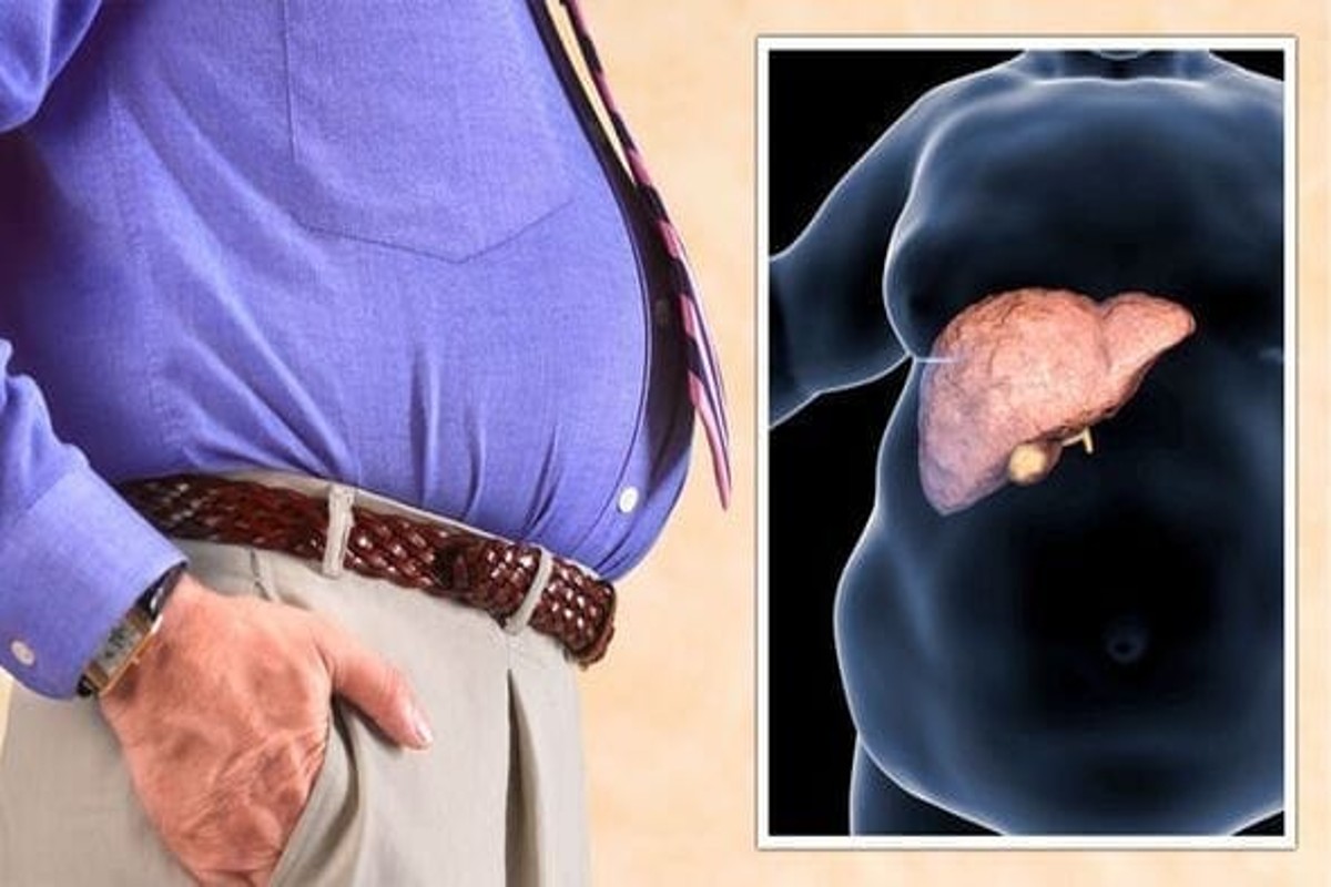 fatty liver