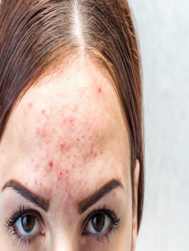 pimples