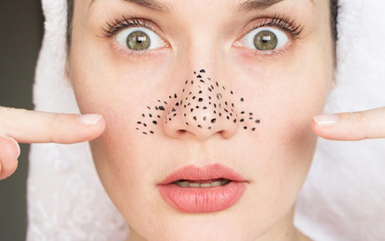 Blackheads: ब्लैकहेड्स हटाना हो जाएगा बिल्कुल आसान, अभी जानें इन होम रेमेडीज के बरे में