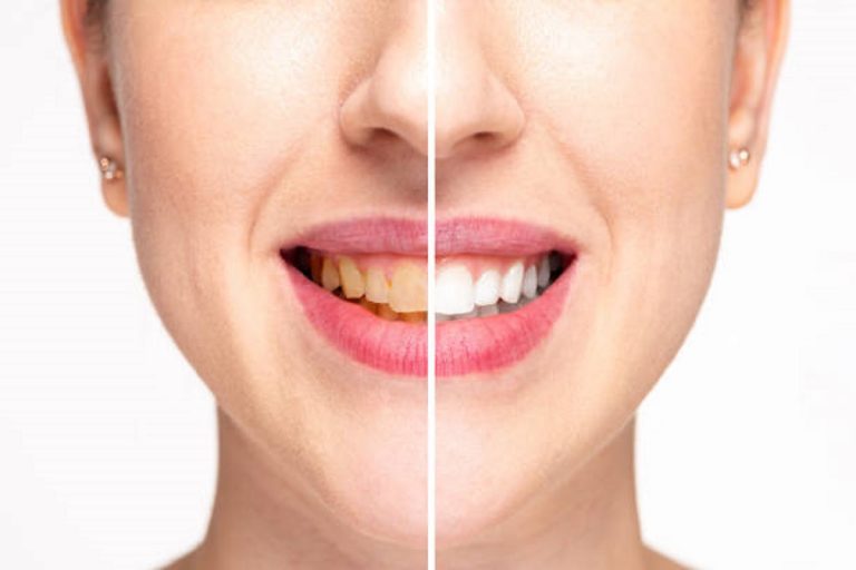 Oral Care: अपने दांतों को सफेद और चमकदार बनाना चाहते हैं? अपनाए से 5 आदतें
