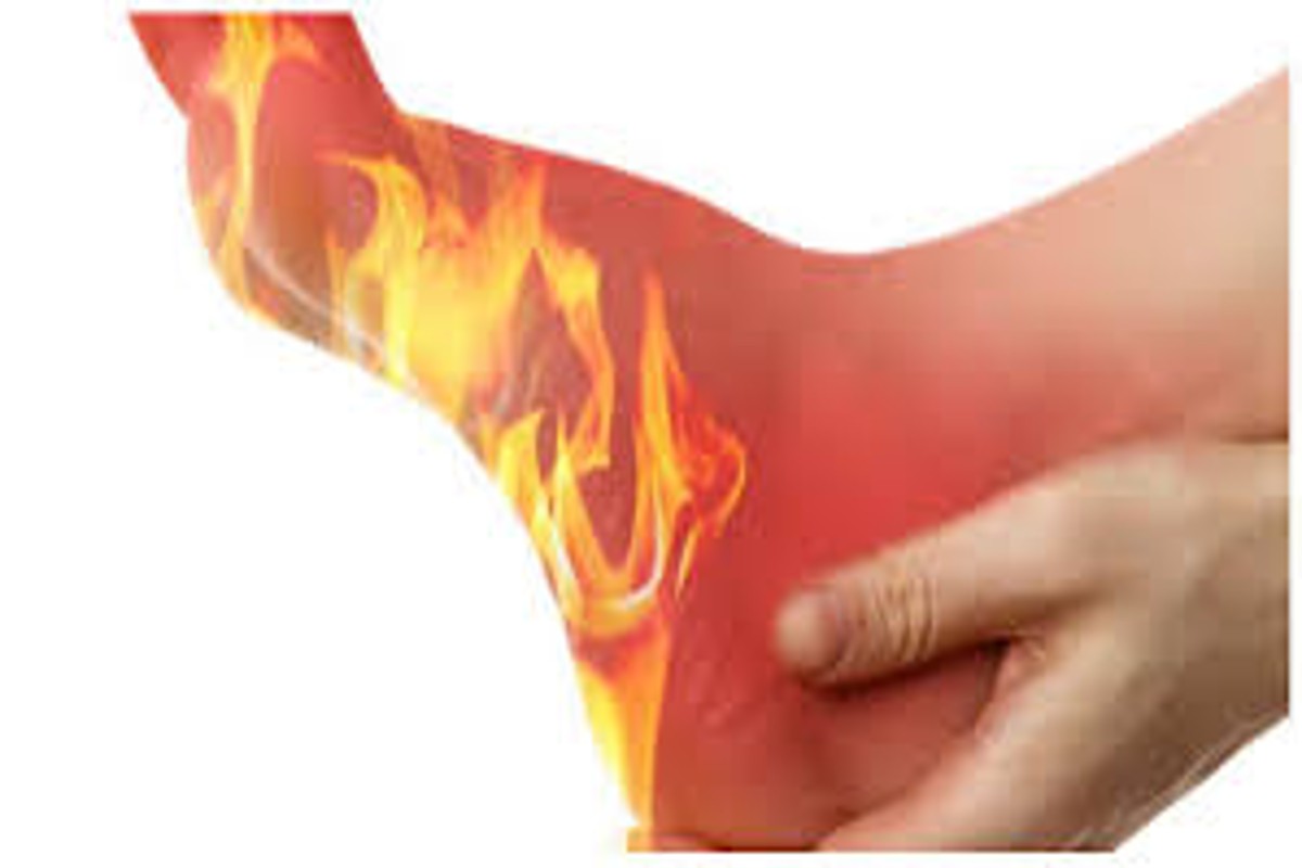 Burning sensation in the soles