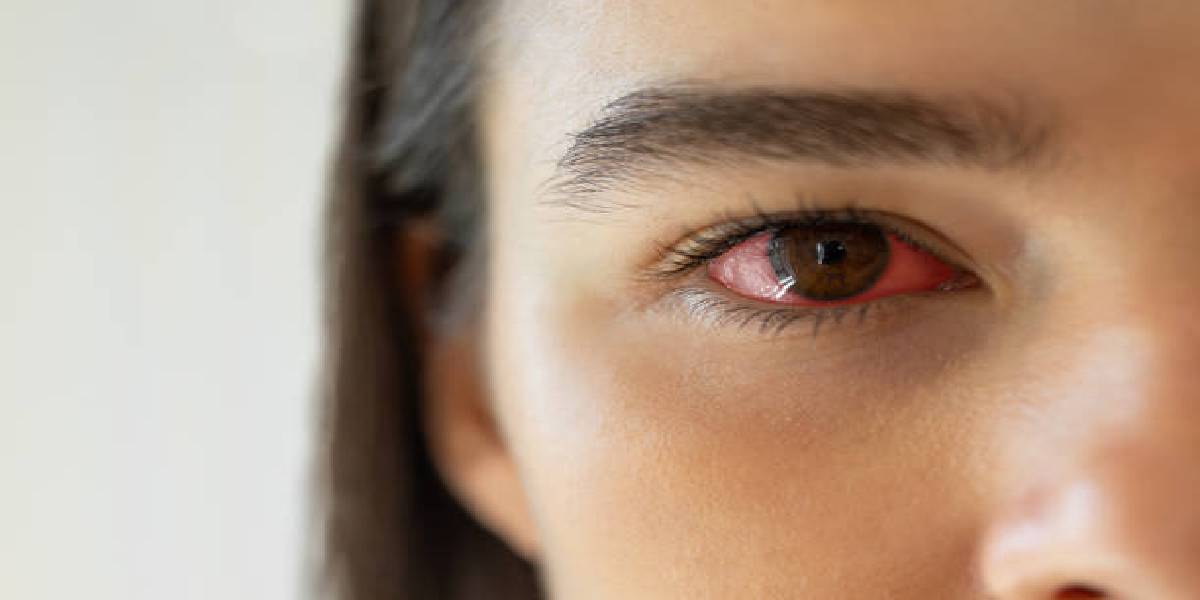 Eye Care in Monsoon