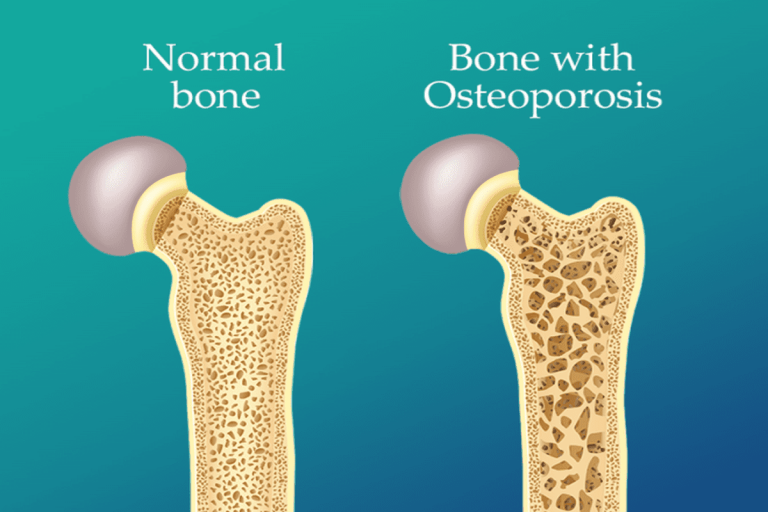 Low Bone Density : महिलाओं में क्यों होती है लो बोन डेंसिटी की समस्या?