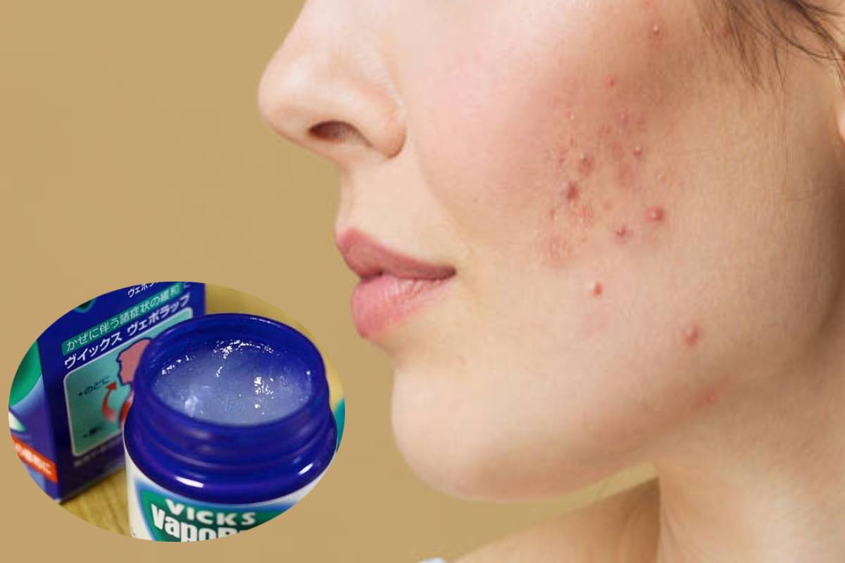 चेहरे पर Vicks लगाने के चमत्कारी फायदे