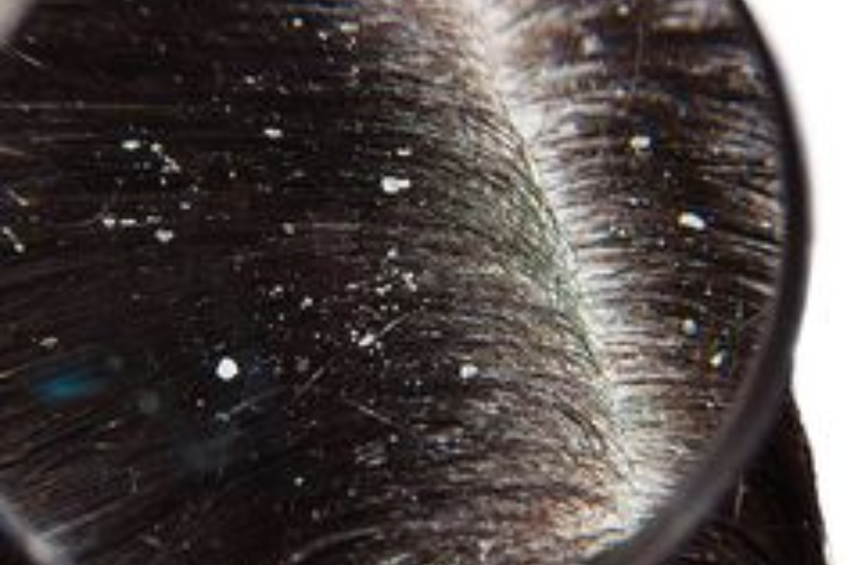 Home Remedies For Dandruff