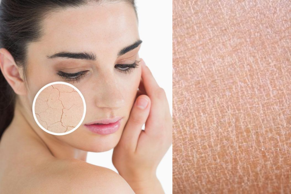 Dry Skin