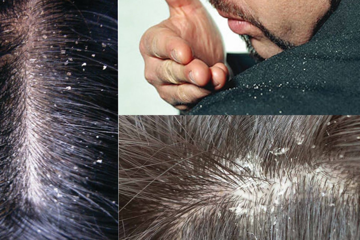 Curd For Dandruff