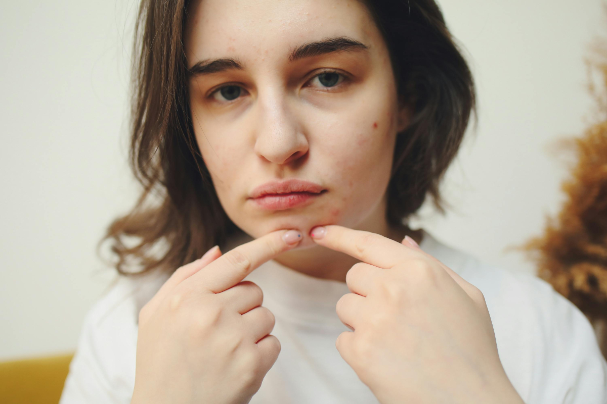 home remedies for pimples