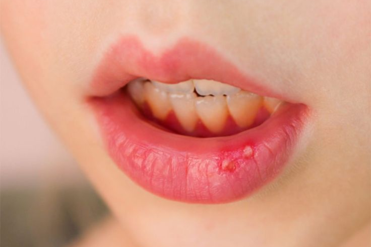 Mouth Ulcer Causes