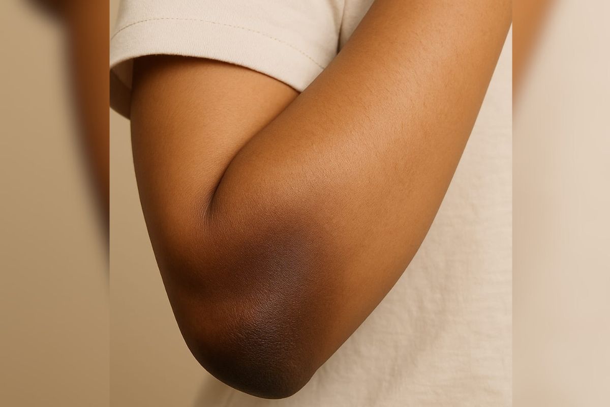 dark elbow