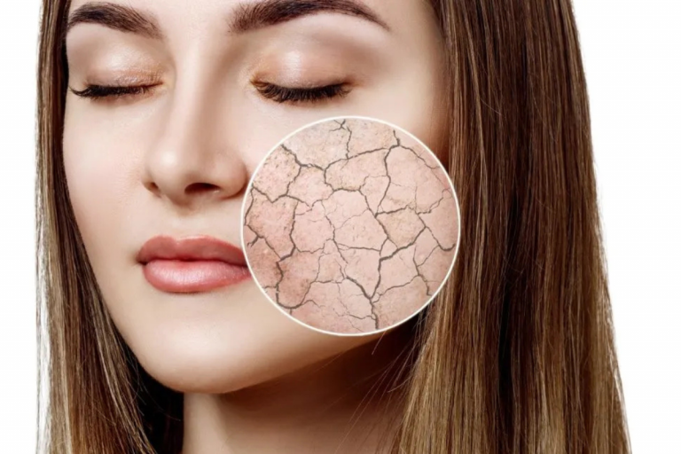 Dry Skin Home Remedies: रूखी स्किन का इलाज है किचन में छुपा, जानिए 5 देसी उपाय