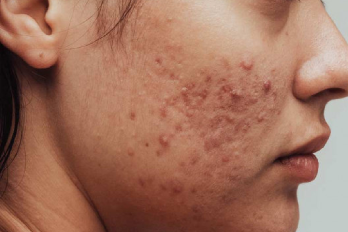 Skin Products For Pimples