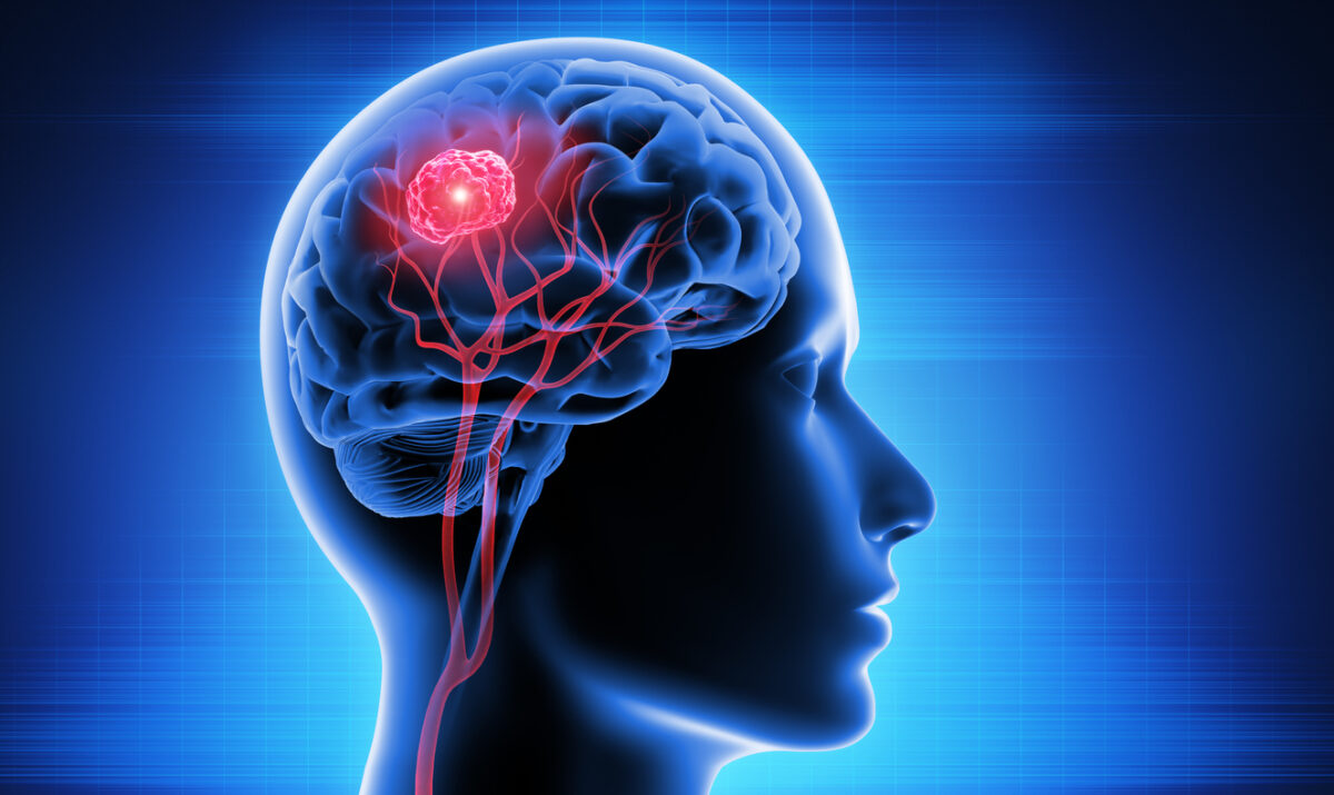 brain cancer diagnosis