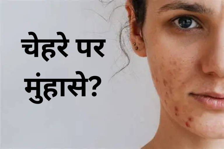Home Remedies for Acne: 7 दिन में चेहरे के मुंहासों से छुटकारा पाएं, जानिए ये 4 आसान और असरदार देसी उपाय