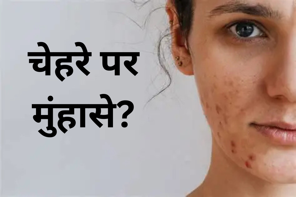 Home Remedies for Acne