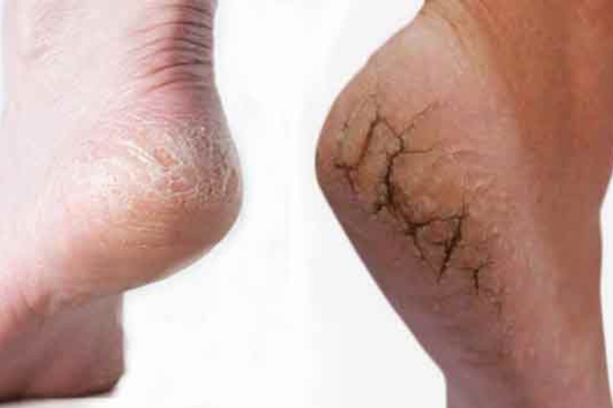 Cracked Heels Treatment