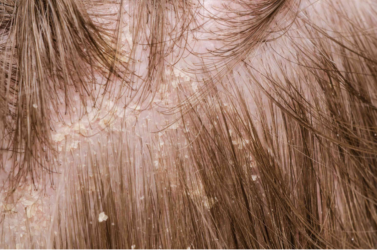 Dandruff Treatment