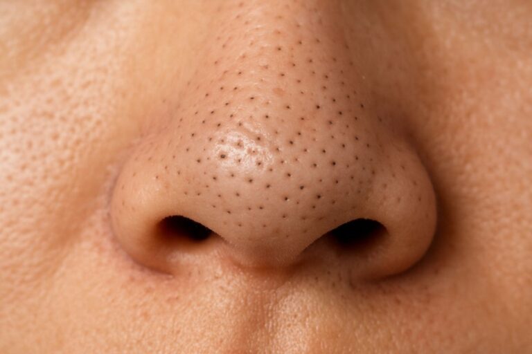 How To Remove Blackheads From Nose: चेहरे की खूबसूरती रहेगी बरकरार, नाक से ब्लैकहेड्स हटाने के लिए अपनाएं ये टिप्स 