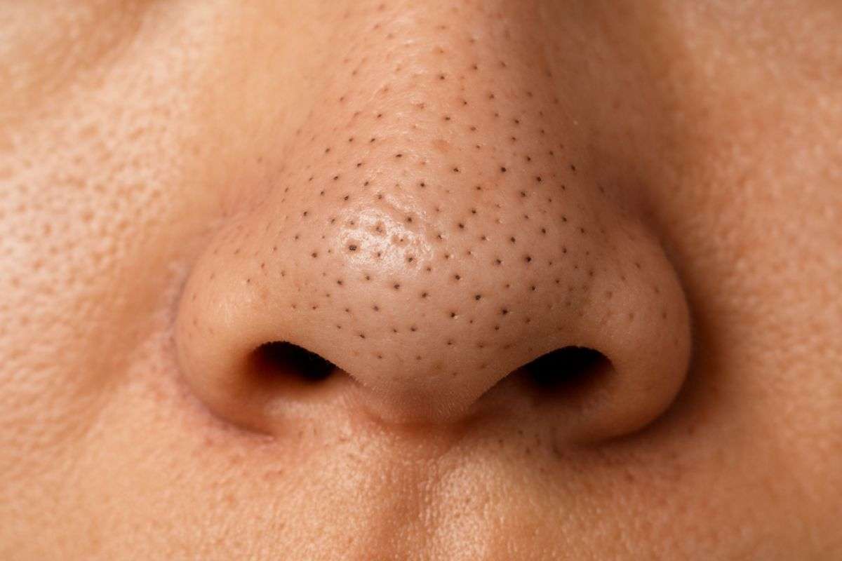 Blackheads Removal Tips