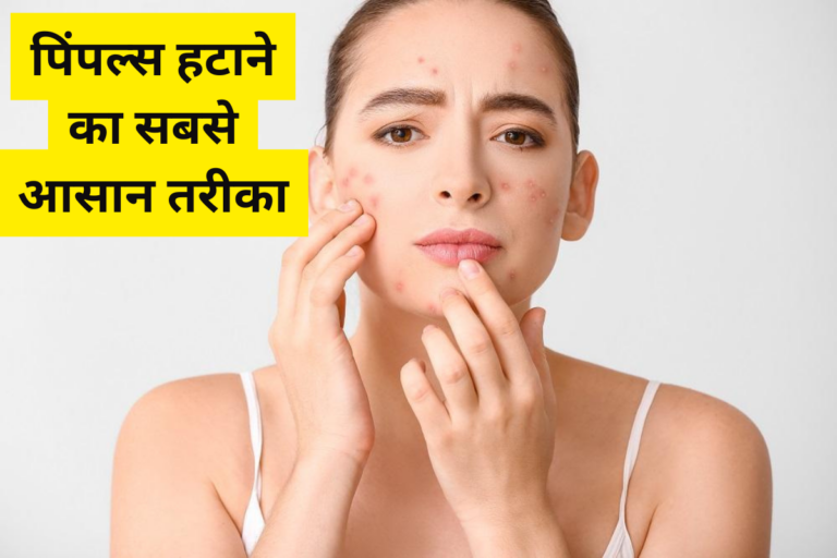 Home Remedies For Pimples: पिंपल्स हटाने का सबसे आसान तरीका, जानें घरेलू नुस्खे जो देंगे तुरंत राहत