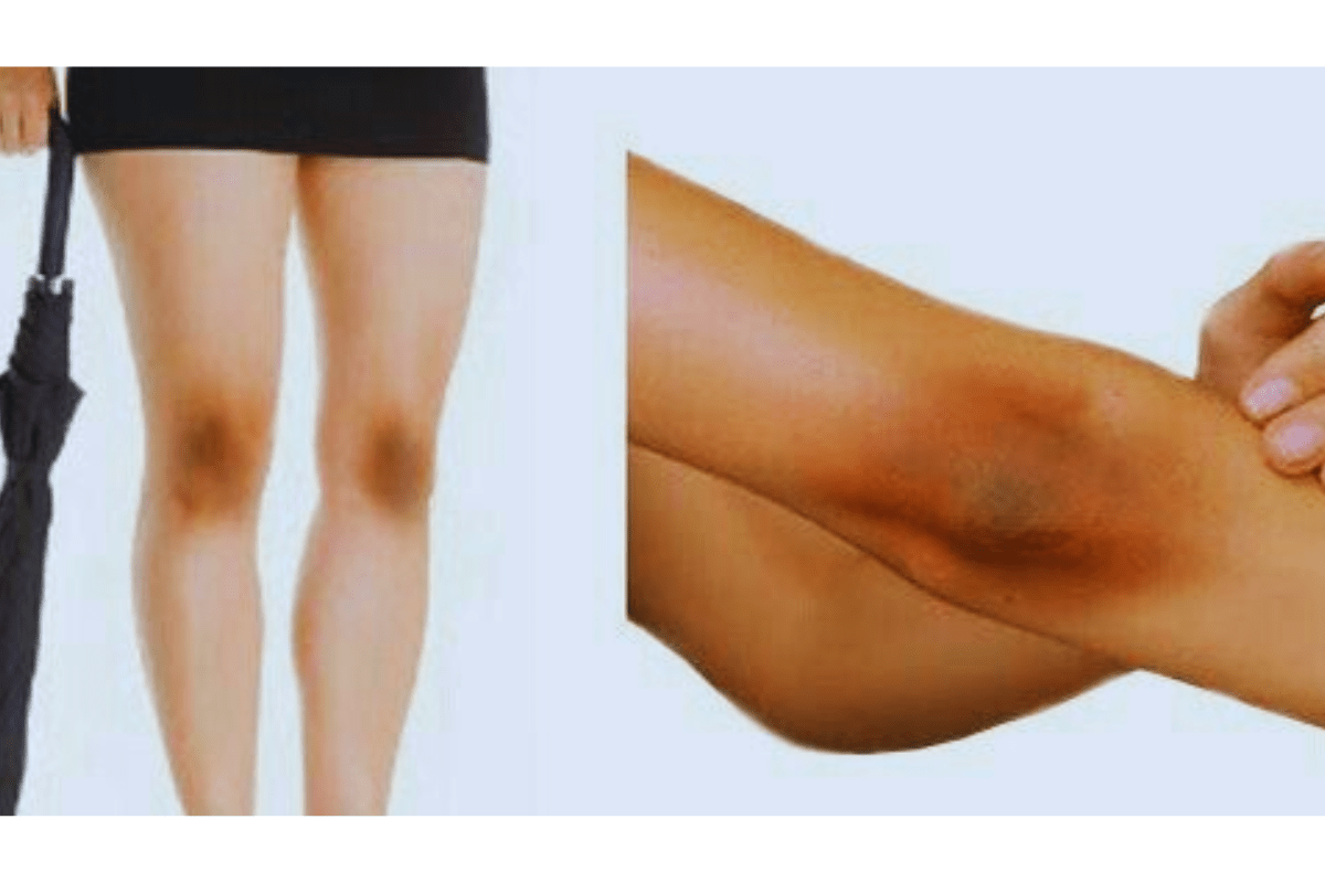 Elbow darkness removal home remedies