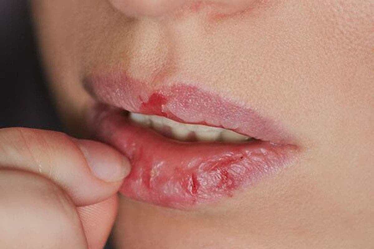 Cracked Lips Home Remedies