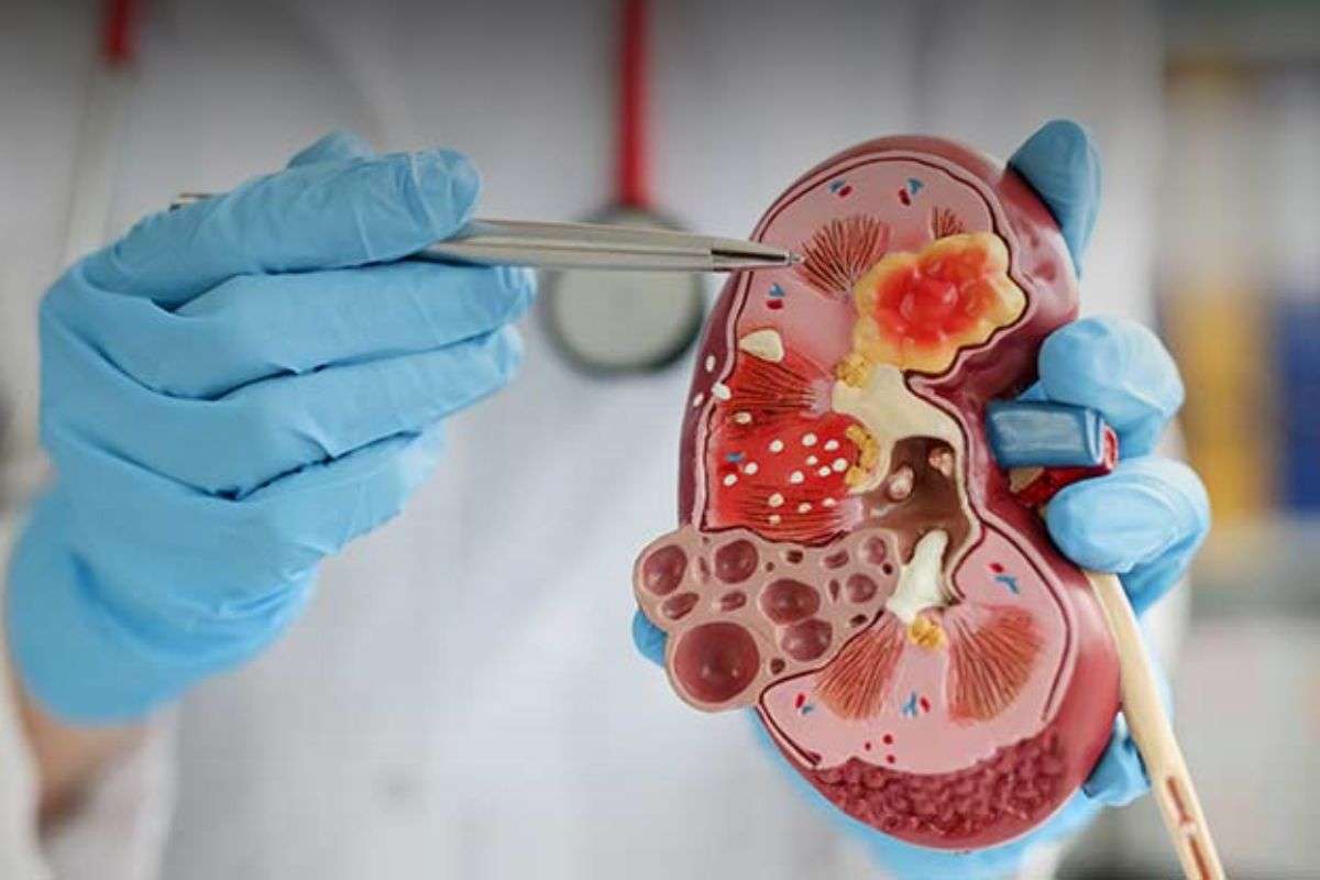 Universal Kidney Transplant