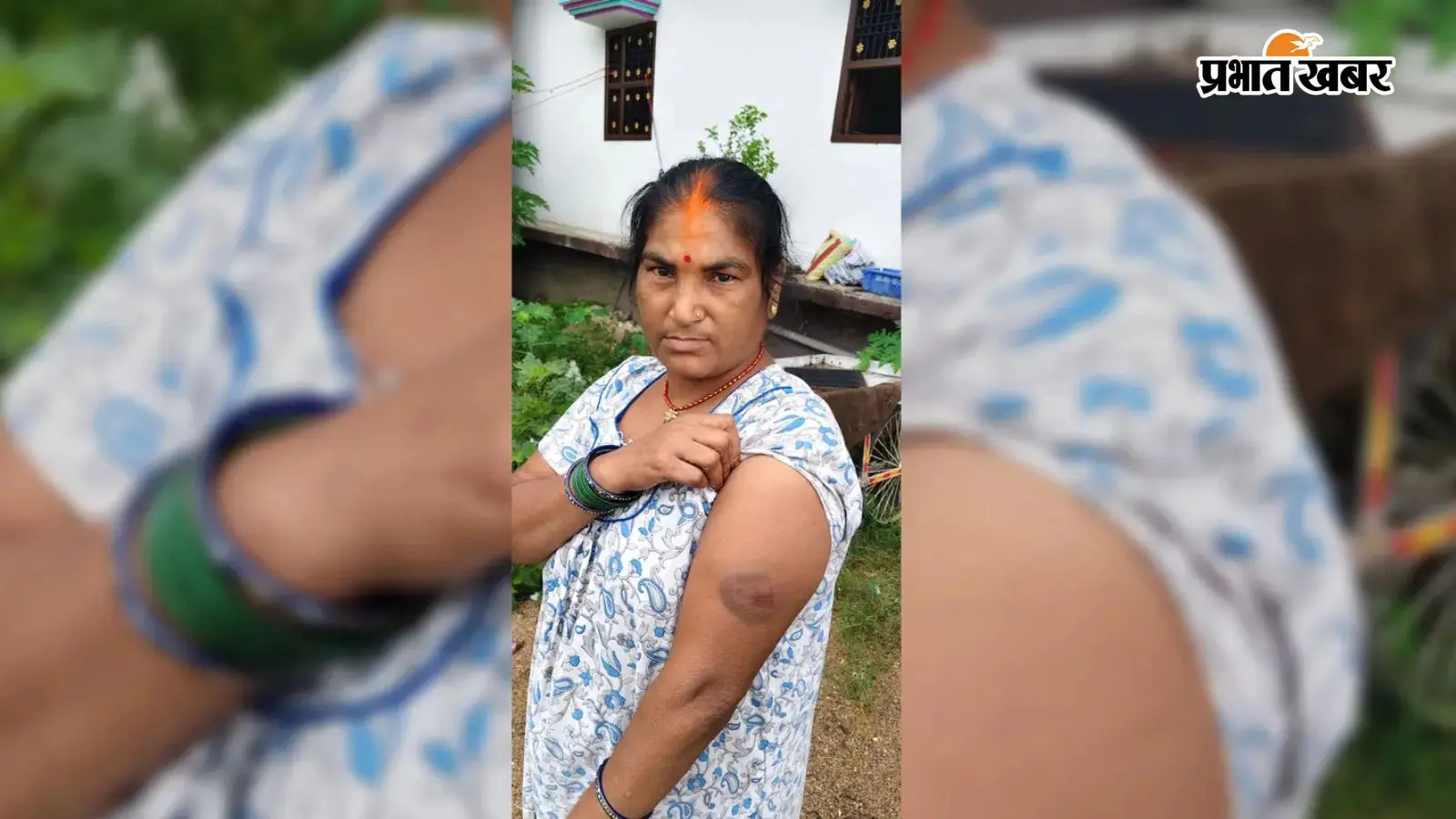 महिला के बाजू को छू कर निकली गोली महिला के बाजू को छू कर निकली गोली